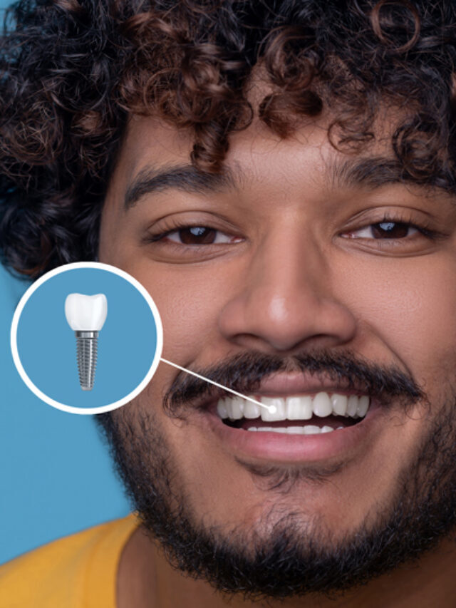 Dental Implant: 7 Tips for Looking After Your Implants