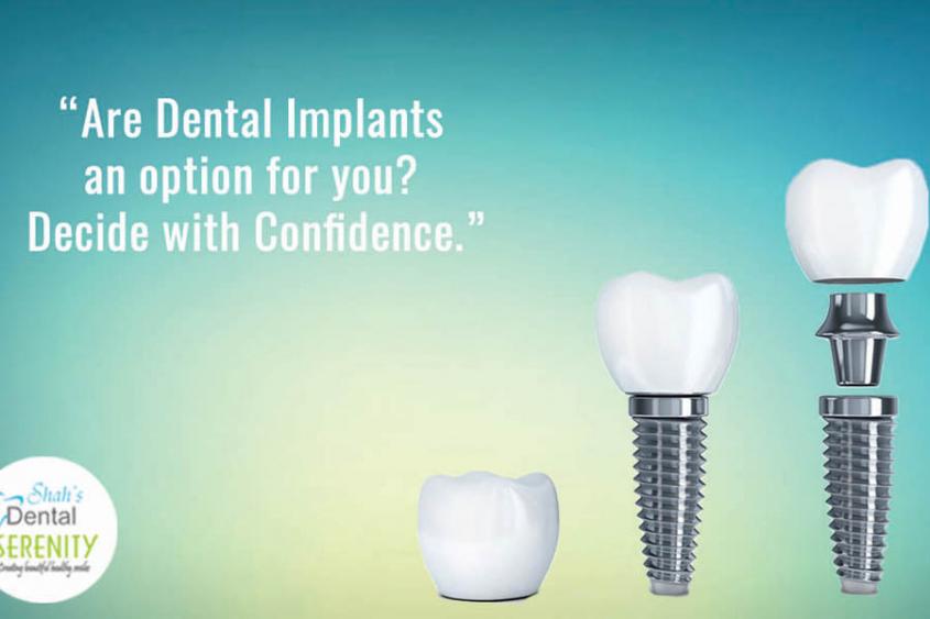 dental implants