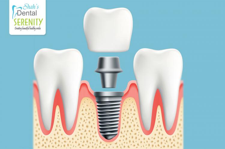 Dental Implants in India