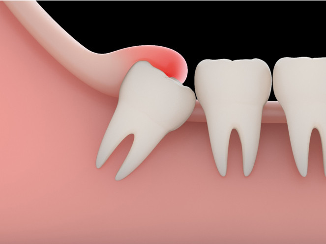 wisdom teeth