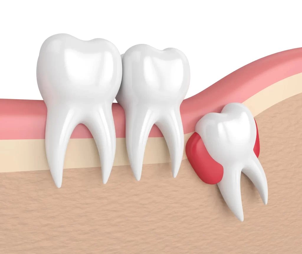 Wisdom Tooth Extraction