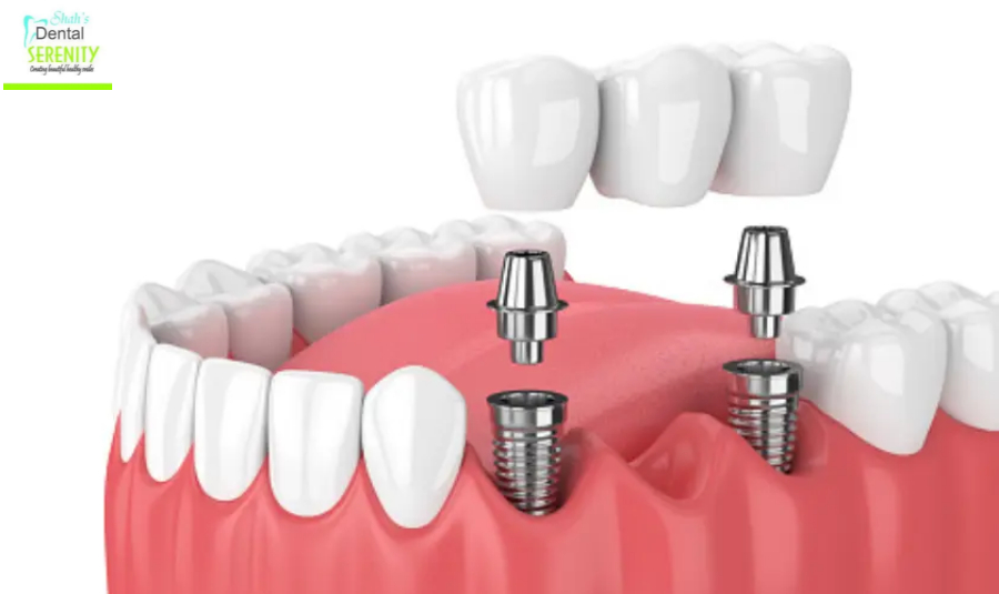 Dental Implants, Tooth Implant, Teeth Implant