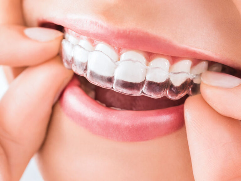 Transparent Orthodontics or Aligners, Orthodontist, Orthodontist In Mumbai, Invisible Aligners