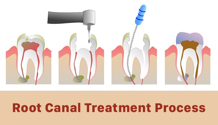 Root Canal Treatment, Root Canal Specialist