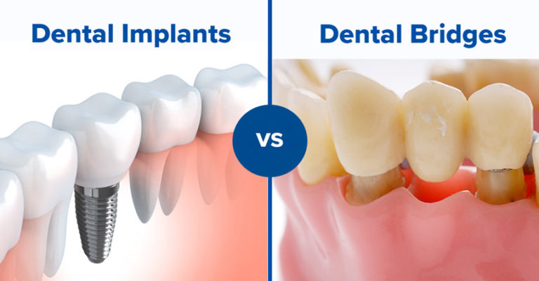 Dental Implants or Dental Bridges: Which One To Choose?
