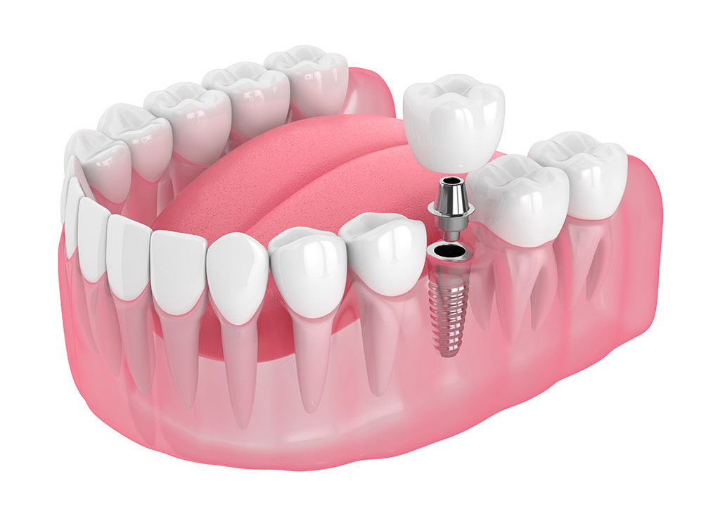 Dental Implants, Tooth Implant, Teeth Implant