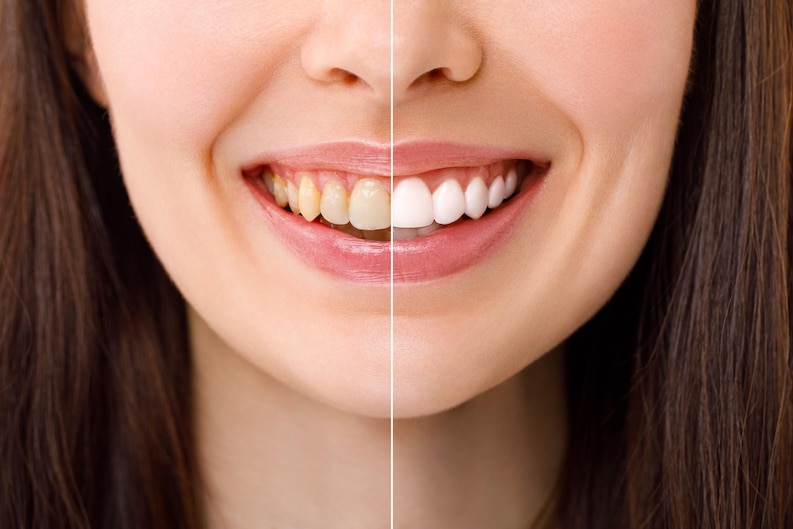 Smile Confidently: How Teeth Whitening Can Transform Your Life