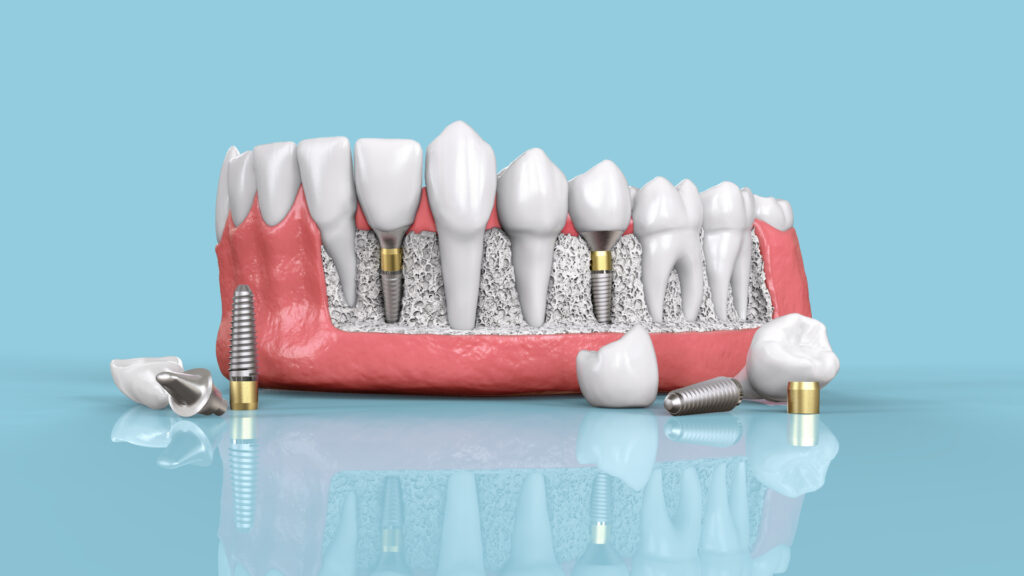 Dental Implant Surgery