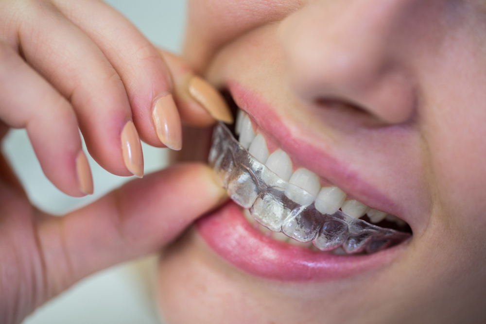 The Benefits of Choosing Invisible Braces for a Confident Smile