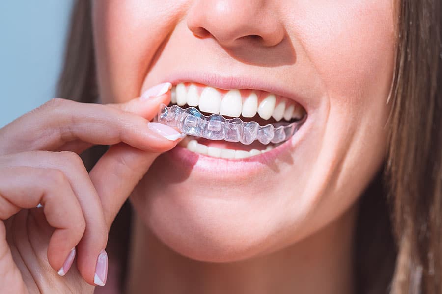 Invisible Aligners