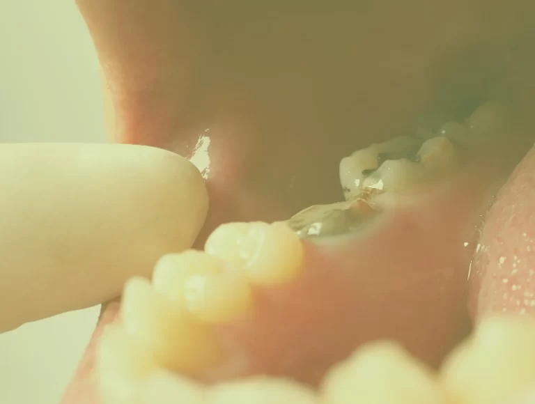 Root Canal Treatment