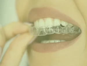 Dental Aligners Treatment In Mumbai