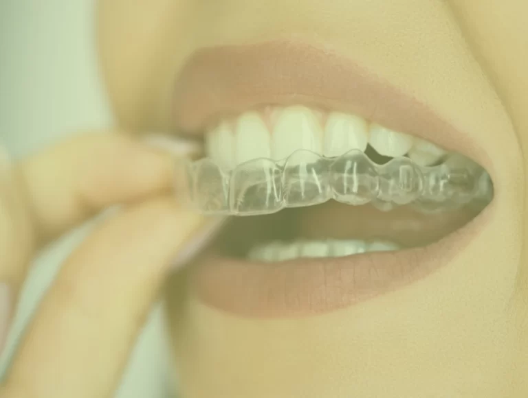 Dental Aligners Treatment In Mumbai
