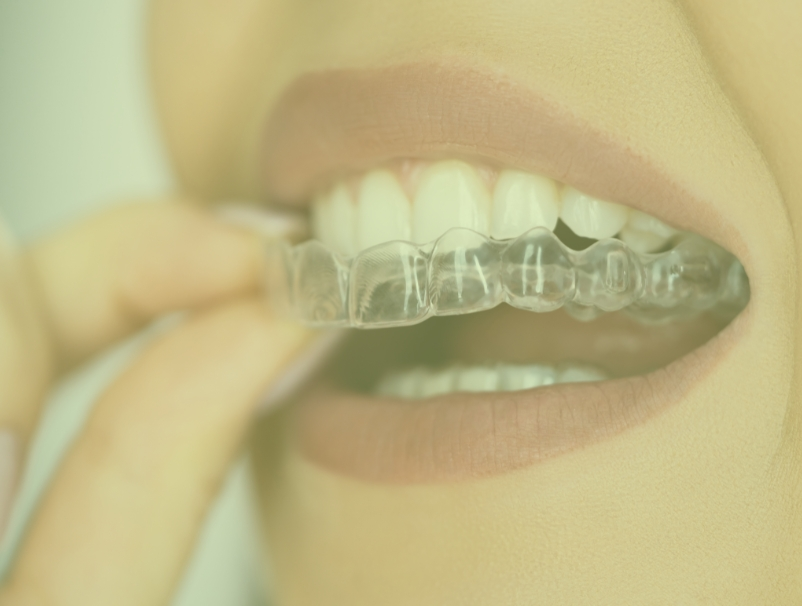 Dental Aligners Treatment In Mumbai